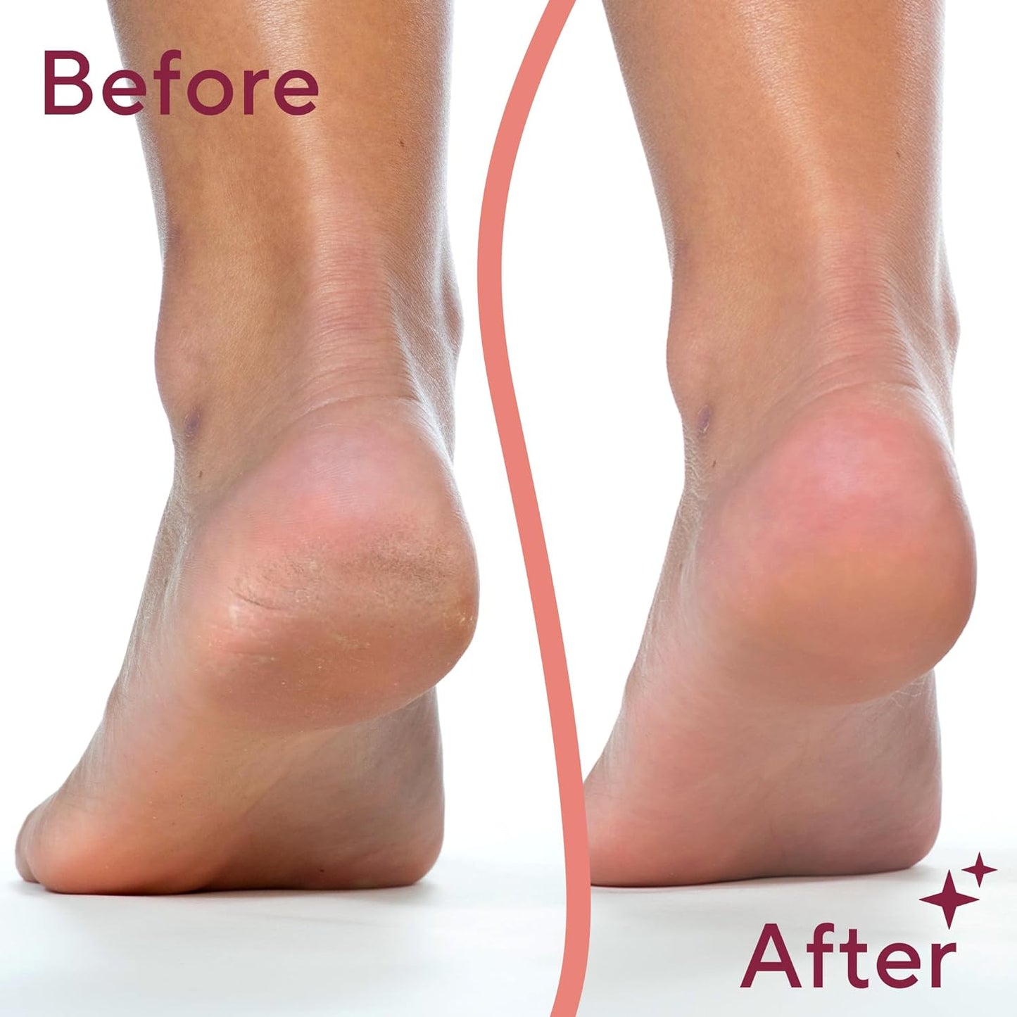 Vital® Callus & Dead Skin Remover